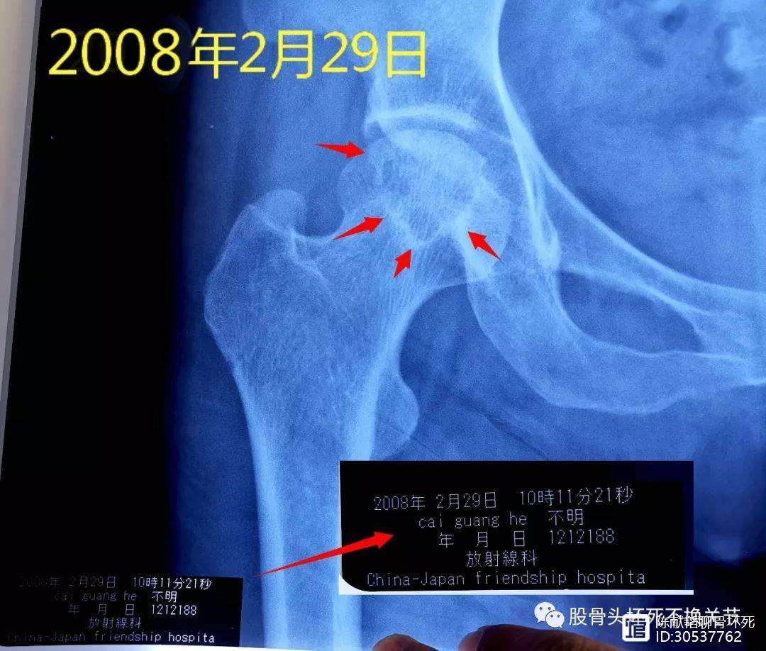 辽阳人工骨头医保报销多少(人工骨头医保报销多少比例)